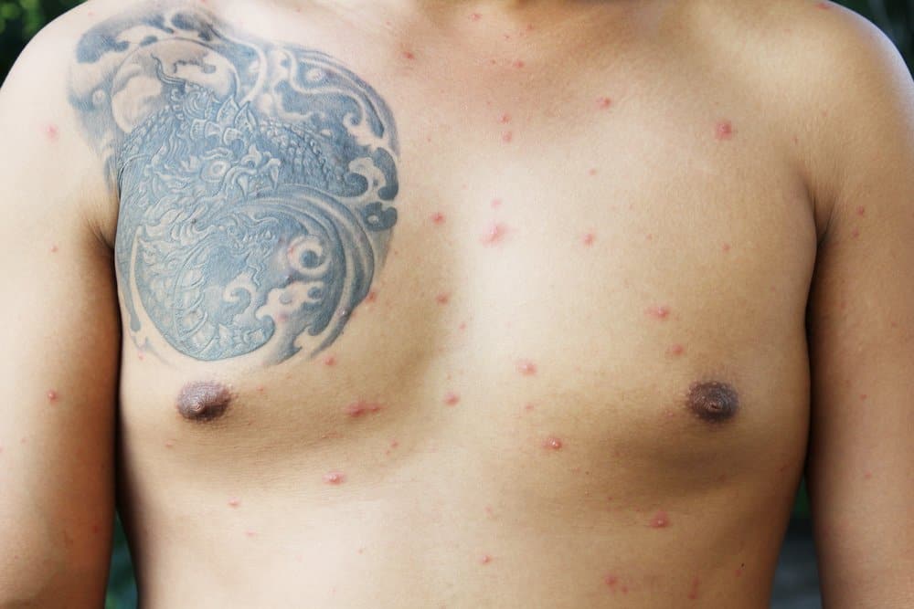 man with red bumps on tattooed chest