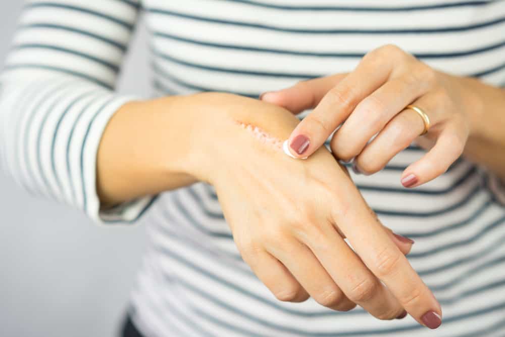 A woman applying scar removal cream on her hand