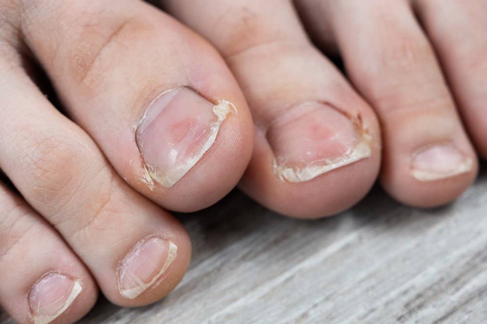 feet with overgrown cuticles and fungus