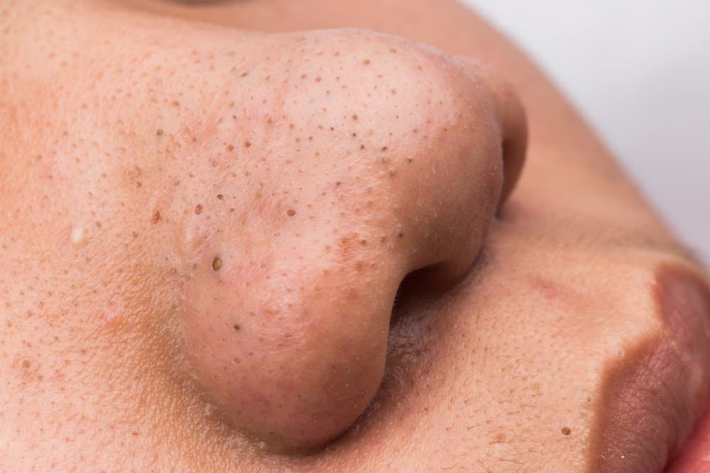 female nose with blackheads