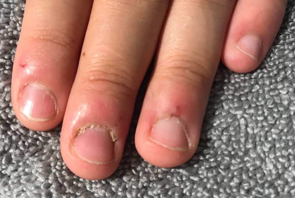 un-manicured nails with hangnails