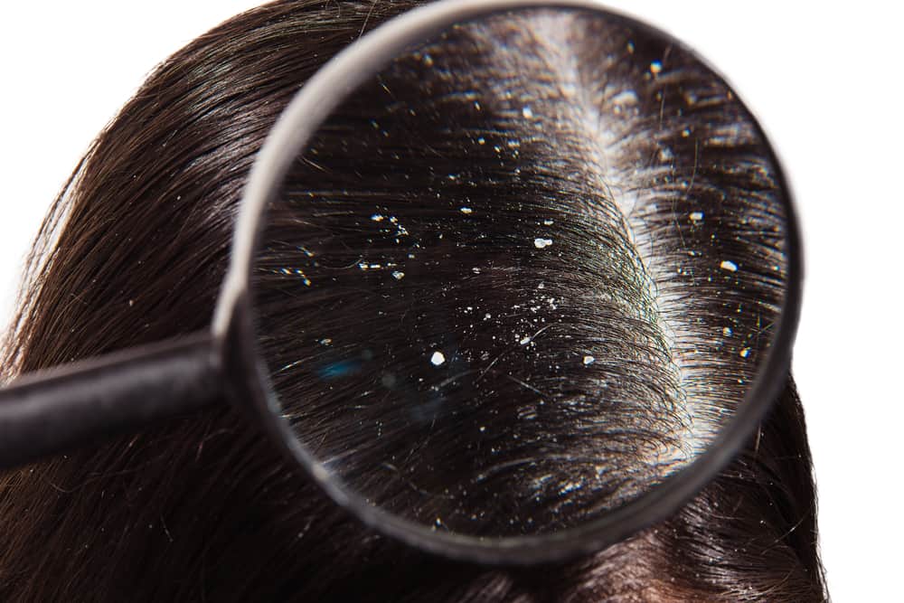 closeup of dandruff on hair scalp