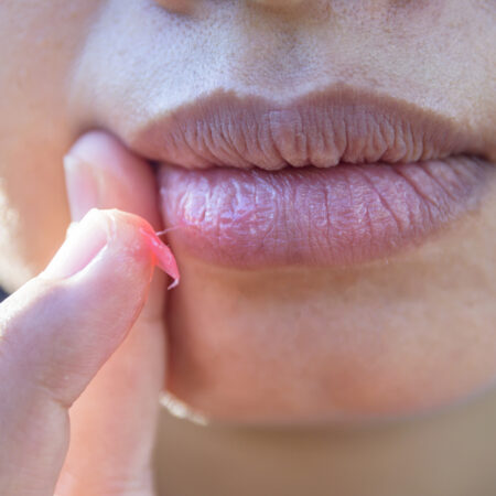 How to Heal Cracked Lip Corners Fast