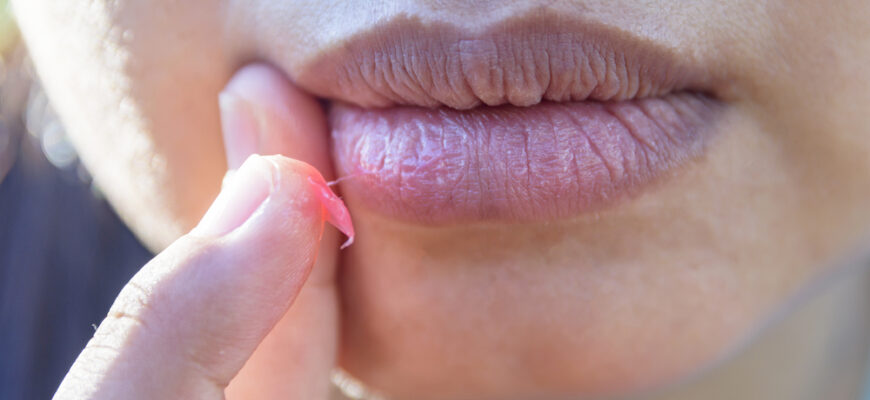 how-to-heal-cracked-lip-corners-fast-beauty-mag