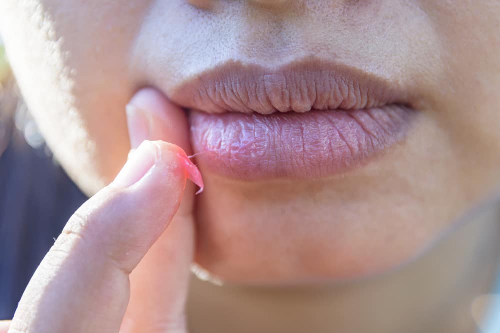 How To Heal Cuts On Corner Of Lips