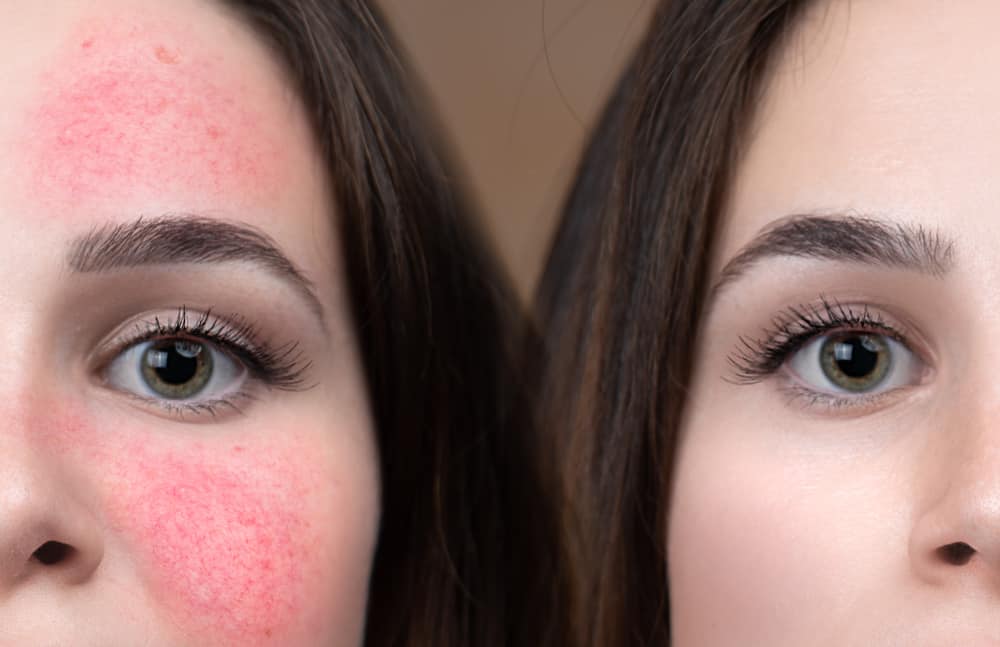 woman with rosacea before and after makeup