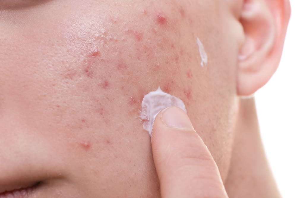 scar removal cream on acne