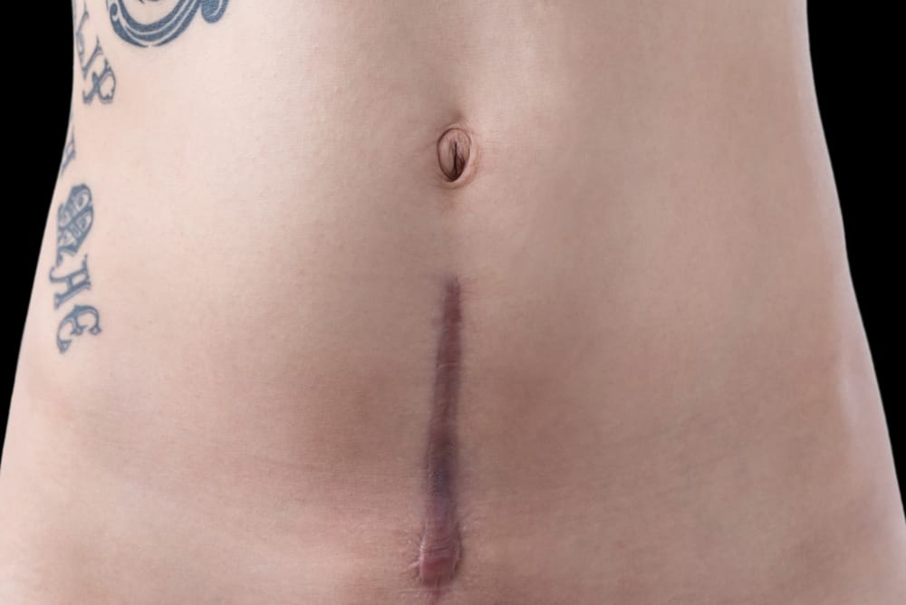 tattoo for cesarean scar
