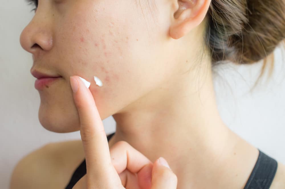 woman spreading anti-acne products on her face