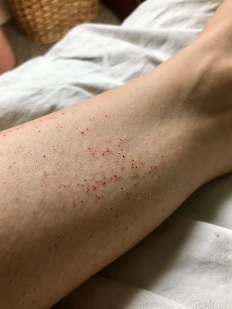 razor burn on leg