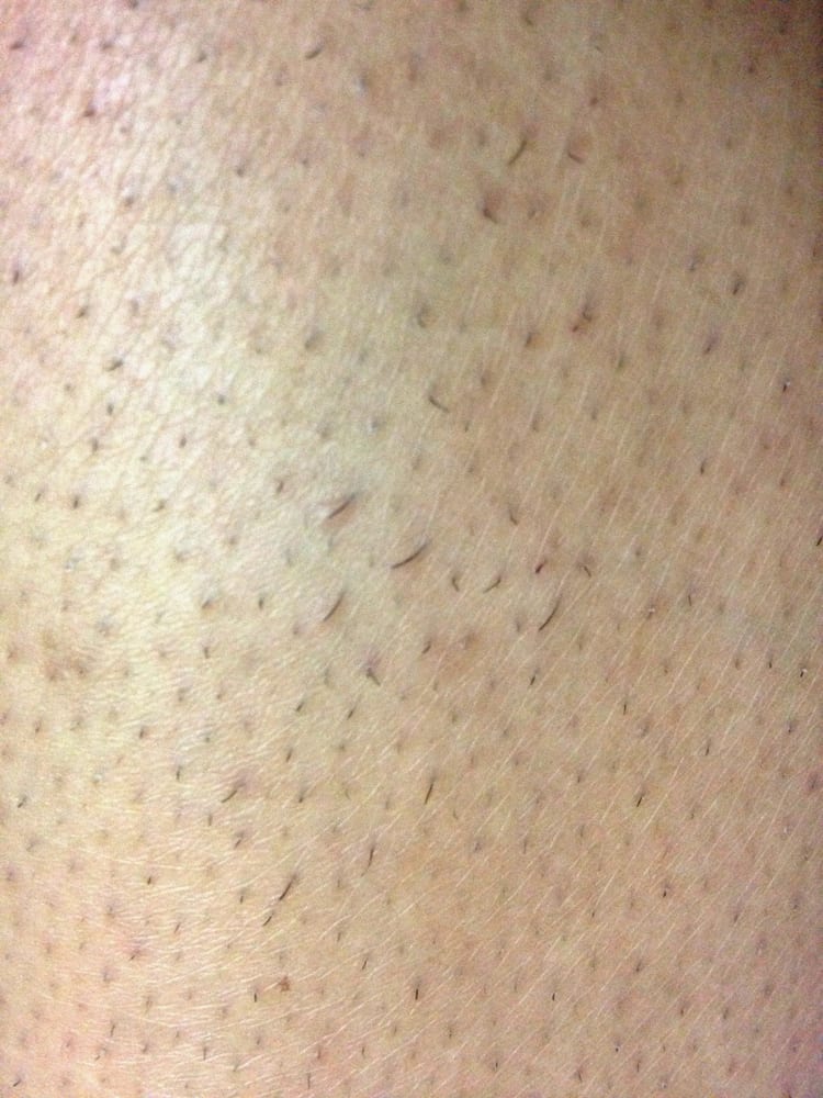 mild, non-inflamed razor bumps