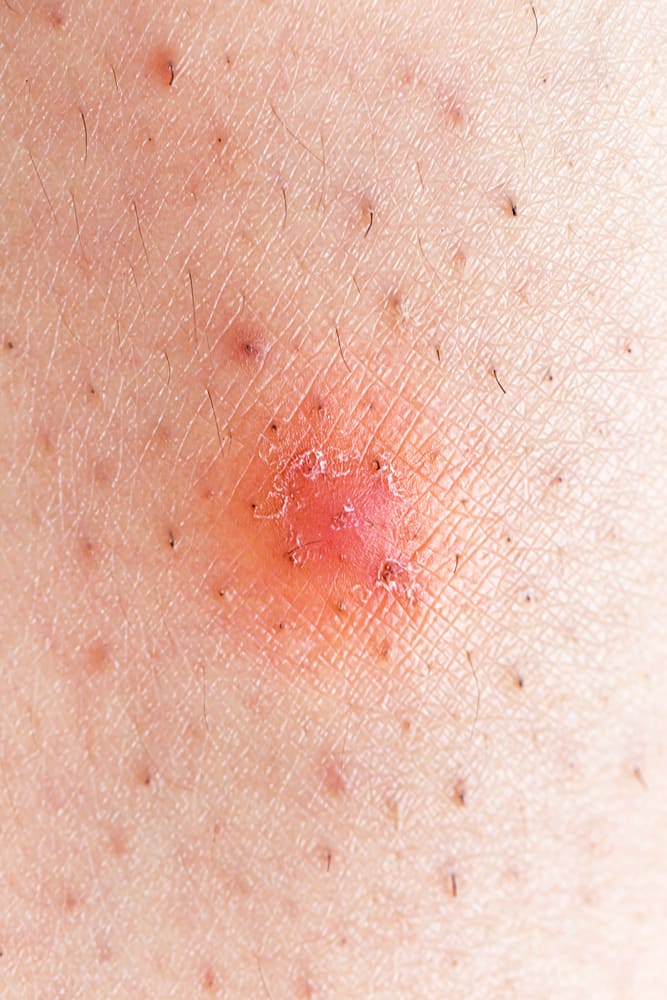 inflamed razor bump