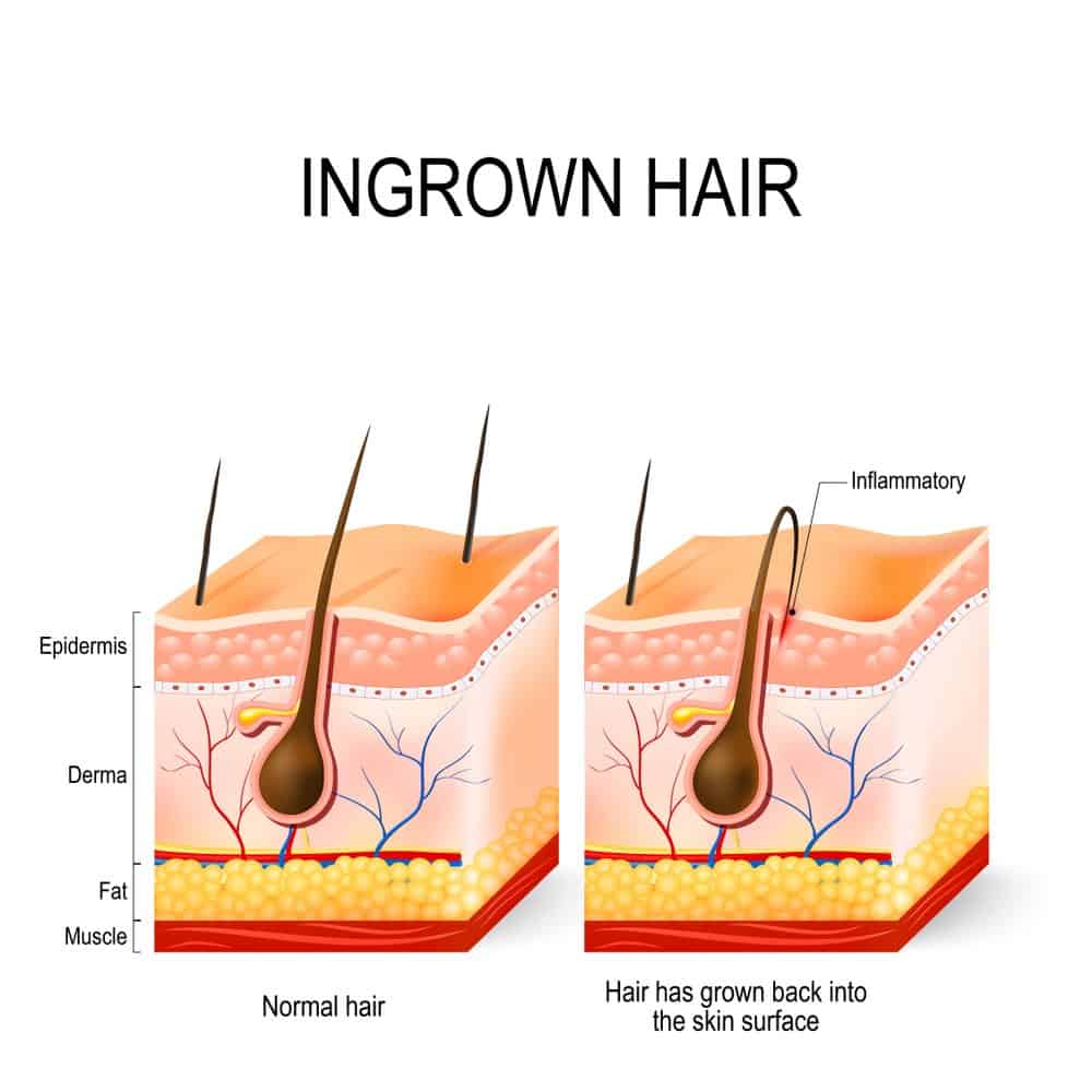 how razor bumps form