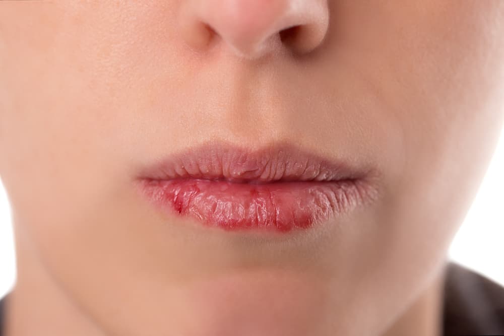 woman with sore cracked lips